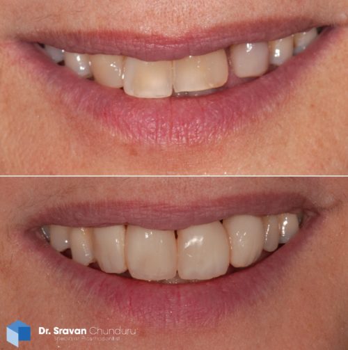 Cracked Tooth Repair Adelaide: 4 Dental Options